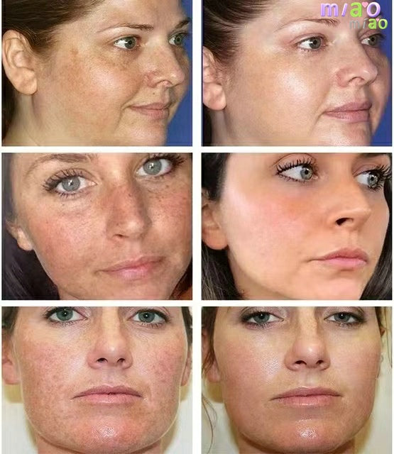 Whitening Freckle Cream Remove Dark Spots Remove Melasma Anti Freckle Cream Fade Pigmentation Skin Anti-Aging Skin Light TIANTIAN LIFE Market Place